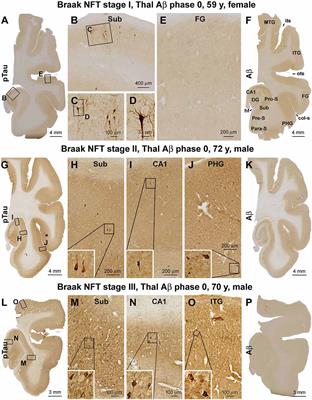 Early Dendritic Dystrophy in Human Brains With Primary Age-Related Tauopathy